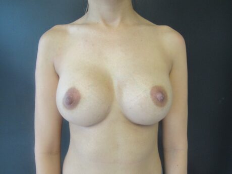 Breast Augmentation case #4639