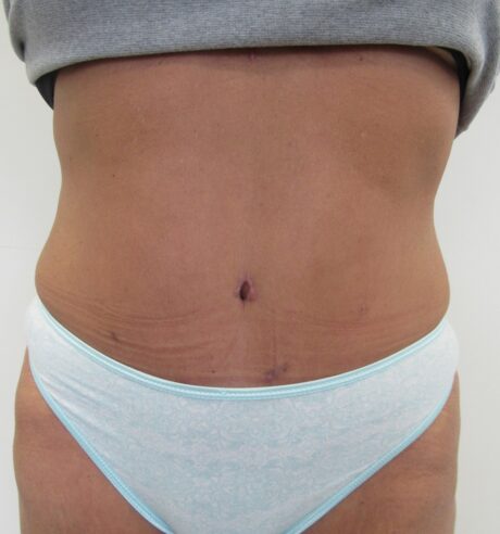 Tummy Tuck case #4127