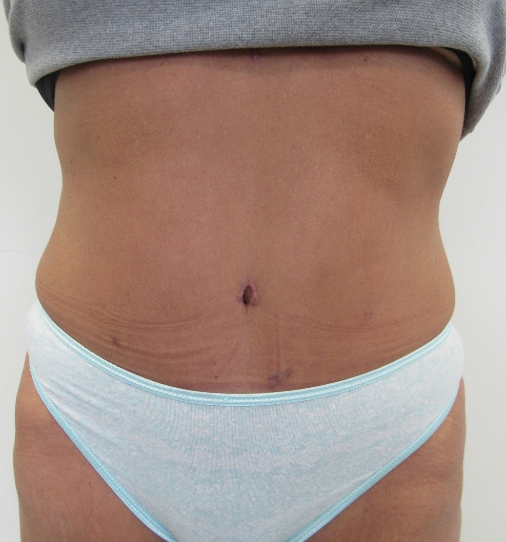 Tummy Tuck