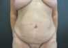 Tummy Tuck case #4127