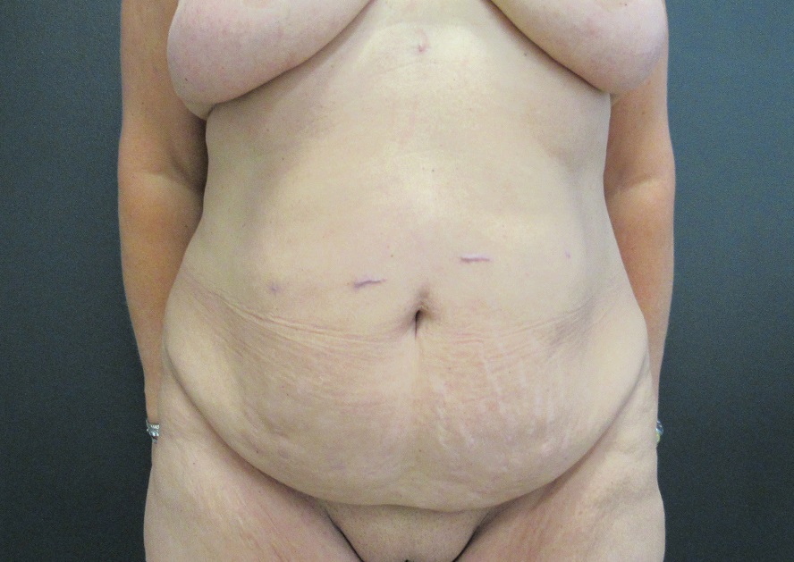 Tummy Tuck