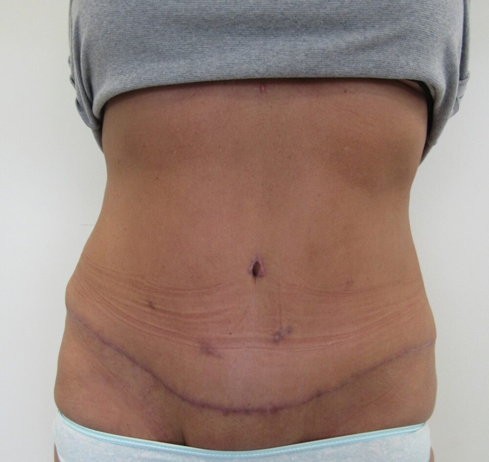 Tummy Tuck case #4127