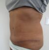 Tummy Tuck case #4127