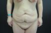 Tummy Tuck case #4134