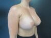 Breast Augmentation case #4644