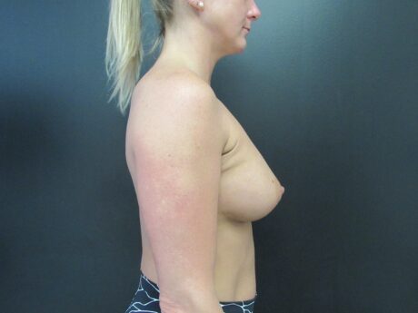 Breast Augmentation case #4644