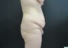 Tummy Tuck case #4134