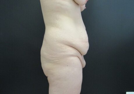 Tummy Tuck case #4134