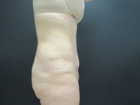 Tummy Tuck case #4134