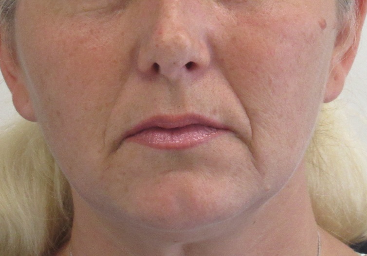 Dermal Fillers case #4337