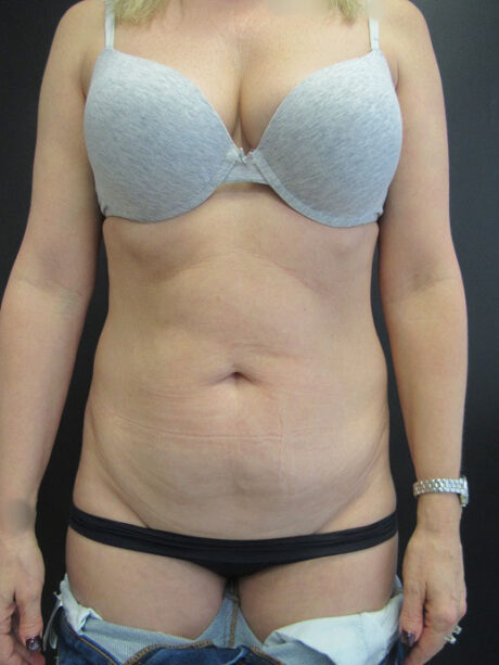 Tummy Tuck case #4141