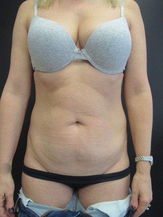 Tummy Tuck