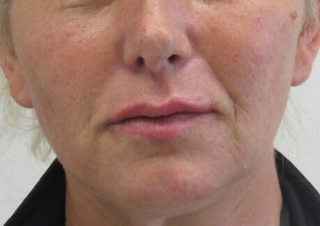 Dermal Fillers case #4337