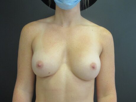 Breast Augmentation case #4651