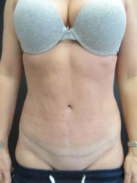 Tummy Tuck case #4141