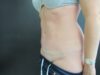 Tummy Tuck case #4141