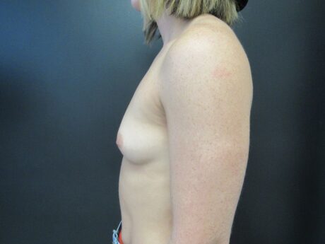 Breast Augmentation case #4651