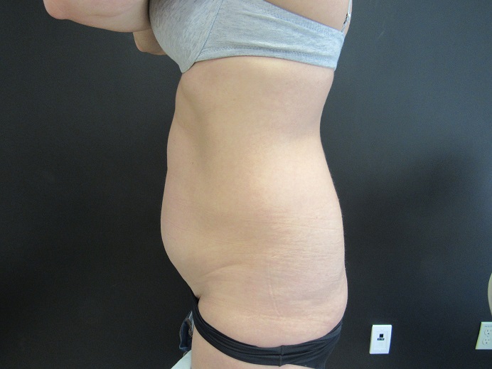 Tummy Tuck case #4141