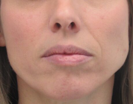 Dermal Fillers case #4340