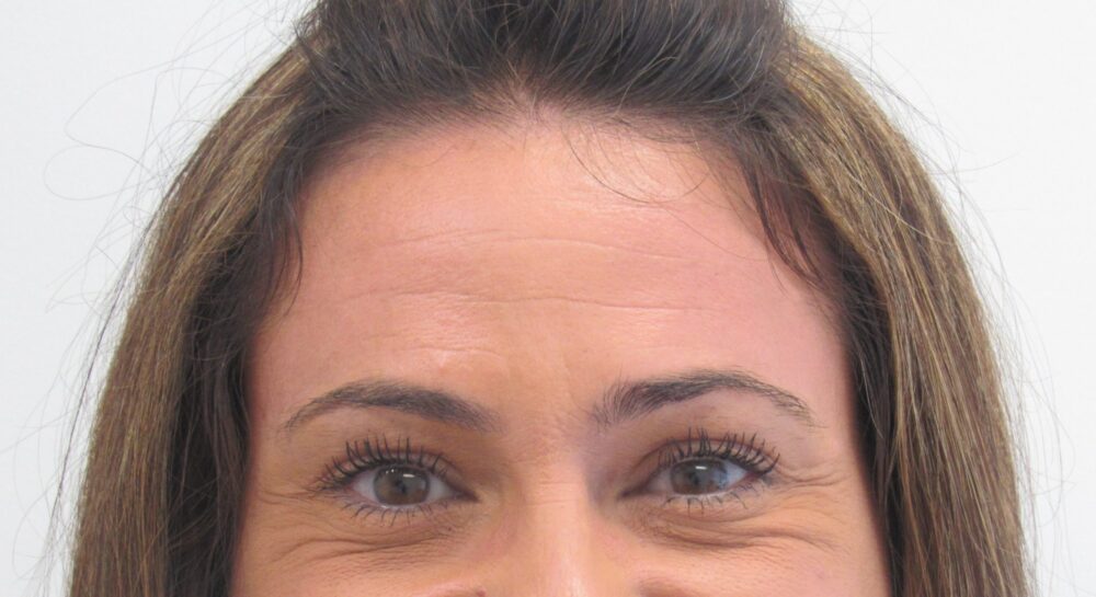 BOTOX® Cosmetic case #4292