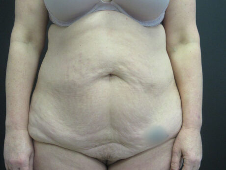 Tummy Tuck case #4148