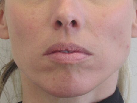 Dermal Fillers case #4340