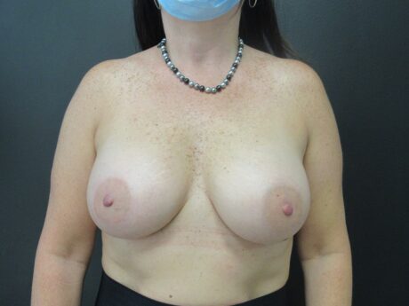 Breast Augmentation case #4658