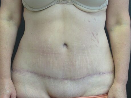 Tummy Tuck case #4148