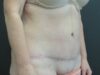 Tummy Tuck case #4148