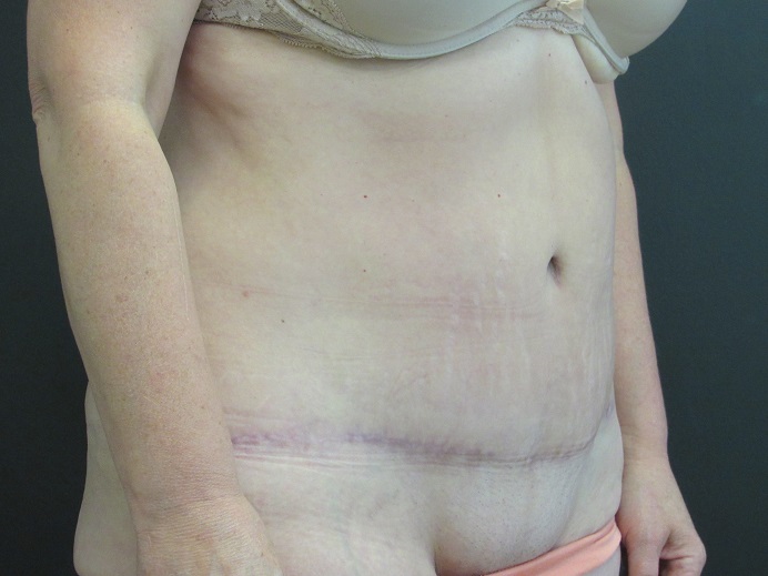 Tummy Tuck
