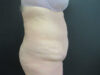 Tummy Tuck case #4148