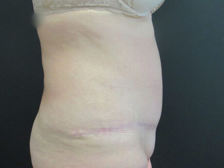 Tummy Tuck case #4148