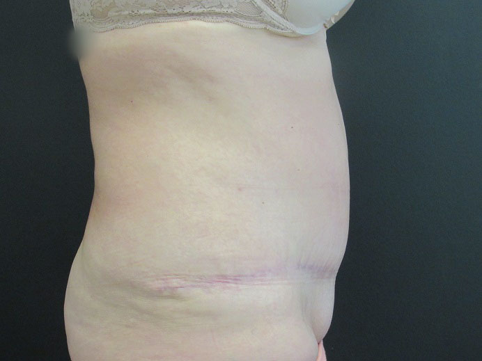 Tummy Tuck