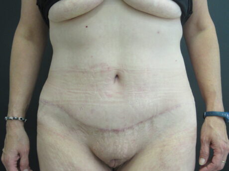 Tummy Tuck case #4155