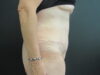 Tummy Tuck case #4155