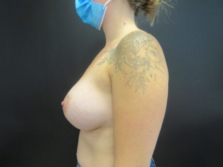 Breast Augmentation case #4665