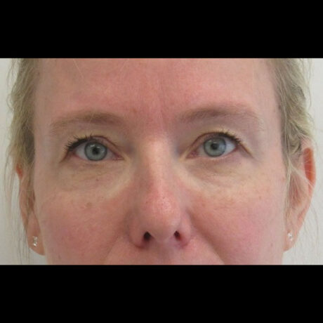 Dermal Fillers case #4346