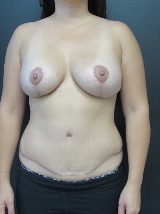 Tummy Tuck