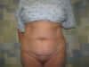 Tummy Tuck case #4166