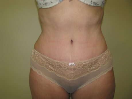 Tummy Tuck case #4166