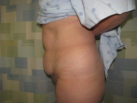 Tummy Tuck case #4166