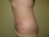 Tummy Tuck case #4166