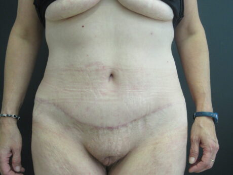 Tummy Tuck case #4171