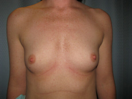 Breast Augmentation case #4693