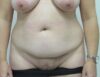 Tummy Tuck case #4178