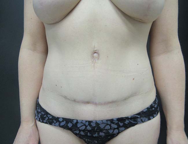 Tummy Tuck case #4178