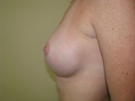 Breast Augmentation case #4693