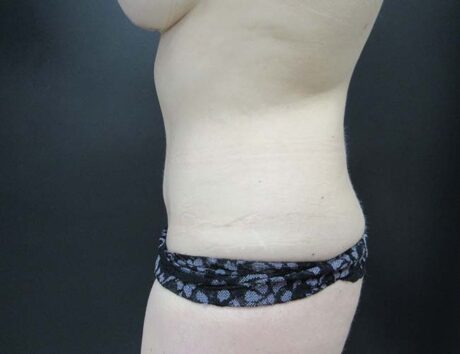 Tummy Tuck case #4178