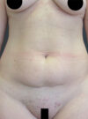 Tummy Tuck case #4185