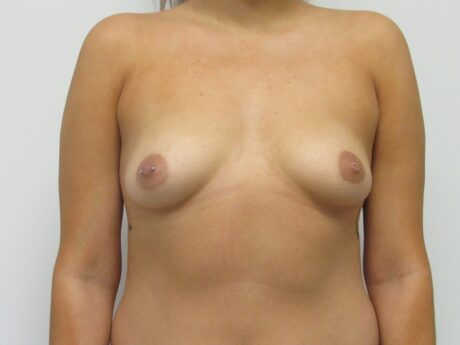 Breast Augmentation case #4702